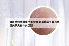 银屑病和风湿哪个更可怕 银屑病关节炎与风湿关节炎有什么区别