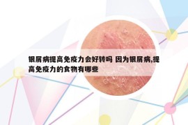 银屑病提高免疫力会好转吗 因为银屑病,提高免疫力的食物有哪些