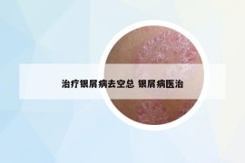 治疗银屑病去空总 银屑病医治