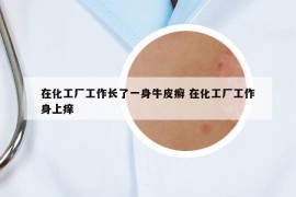 在化工厂工作长了一身牛皮癣 在化工厂工作身上痒
