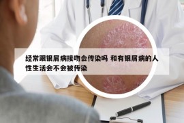 经常跟银屑病接吻会传染吗 和有银屑病的人性生活会不会被传染