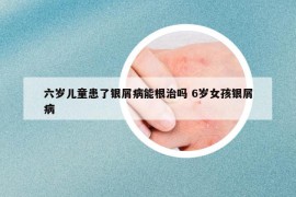六岁儿童患了银屑病能根治吗 6岁女孩银屑病