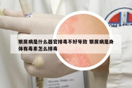 银屑病是什么器官排毒不好导致 银屑病是身体有毒素怎么排毒