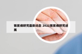 银屑病研究最新动态 2021银屑病研究进展