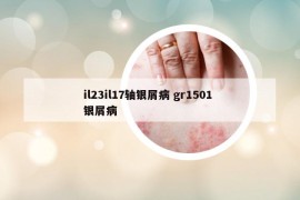 il23il17轴银屑病 gr1501 银屑病
