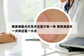 银屑病是大片生长还是只有一块 银屑病是长一大块还是一小点