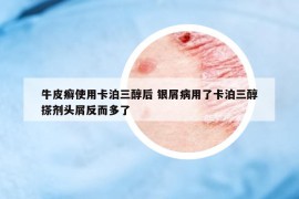 牛皮癣使用卡泊三醇后 银屑病用了卡泊三醇搽剂头屑反而多了