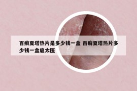 百癣夏塔热片是多少钱一盒 百癣夏塔热片多少钱一盒扈太医