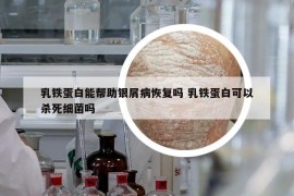 乳铁蛋白能帮助银屑病恢复吗 乳铁蛋白可以杀死细菌吗