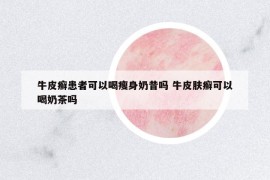 牛皮癣患者可以喝瘦身奶昔吗 牛皮肤癣可以喝奶茶吗