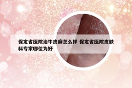 保定省医院治牛皮癣怎么样 保定省医院皮肤科专家哪位为好