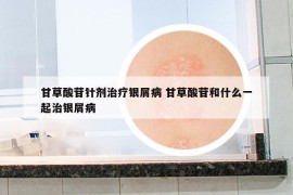甘草酸苷针剂治疗银屑病 甘草酸苷和什么一起治银屑病