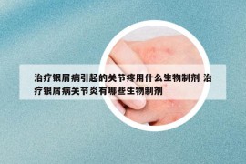 治疗银屑病引起的关节疼用什么生物制剂 治疗银屑病关节炎有哪些生物制剂