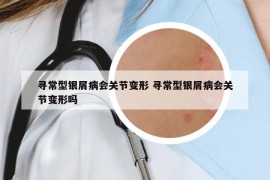 寻常型银屑病会关节变形 寻常型银屑病会关节变形吗