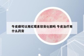牛皮癖可以用红霉素软膏化脓吗 牛皮治疗用什么药膏