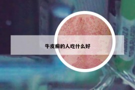 牛皮癣的人吃什么好