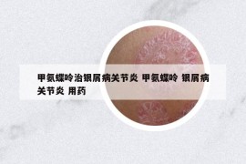 甲氨蝶呤治银屑病关节炎 甲氨蝶呤 银屑病关节炎 用药