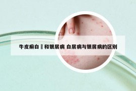 牛皮癣白疕和银屑病 白屑病与银屑病的区别