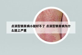 点滴型银屑病小腿好不了 点滴型银屑病为什么腿上严重