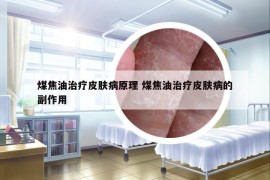 煤焦油治疗皮肤病原理 煤焦油治疗皮肤病的副作用