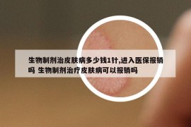 生物制剂治皮肤病多少钱1针,进入医保报销吗 生物制剂治疗皮肤病可以报销吗