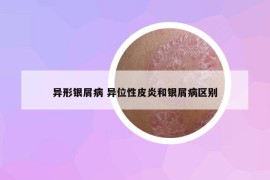 异形银屑病 异位性皮炎和银屑病区别
