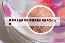 银屑病老有黄鼻涕 银屑病老有黄鼻涕怎么治疗