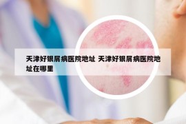 天津好银屑病医院地址 天津好银屑病医院地址在哪里