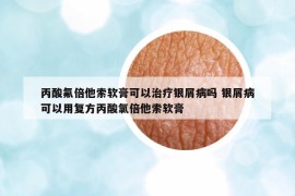 丙酸氟倍他索软膏可以治疗银屑病吗 银屑病可以用复方丙酸氯倍他索软膏