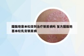 醋酸地塞米松搽剂治疗银屑病吗 复方醋酸地塞米松乳膏银屑病
