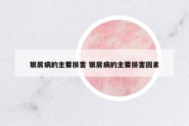 银屑病的主要损害 银屑病的主要损害因素