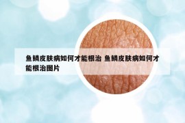 鱼鳞皮肤病如何才能根治 鱼鳞皮肤病如何才能根治图片