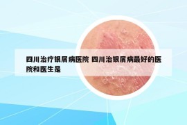 四川治疗银屑病医院 四川治银屑病最好的医院和医生是