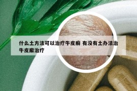 什么土方法可以治疗牛皮癣 有没有土办法治牛皮廨治疗