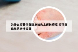为什么打着依奇珠单抗头上还长癣呢 打依奇珠单抗治疗效果