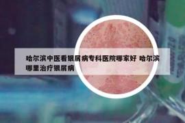 哈尔滨中医看银屑病专科医院哪家好 哈尔滨哪里治疗银屑病