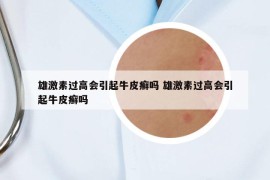 雄激素过高会引起牛皮癣吗 雄激素过高会引起牛皮癣吗