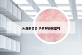 头皮癣忌口 头皮癣会自愈吗