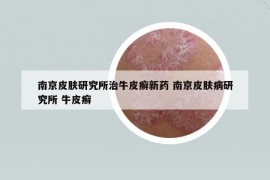 南京皮肤研究所治牛皮癣新药 南京皮肤病研究所 牛皮癣