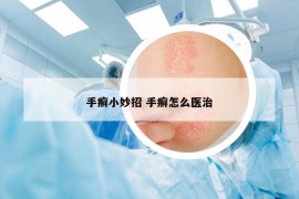 手癣小妙招 手癣怎么医治