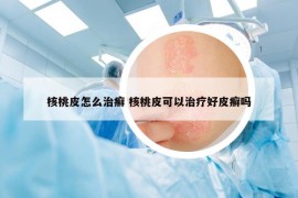 核桃皮怎么治癣 核桃皮可以治疗好皮癣吗
