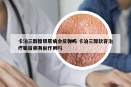 卡泊三醇擦银屑病会反弹吗 卡泊三醇软膏治疗银屑病有副作用吗
