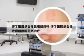 得了银屑病会导致眼睛痒吗 得了银屑病会导致眼睛痒吗怎么治疗