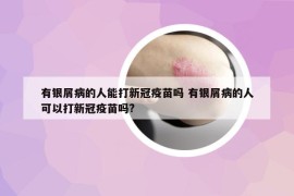 有银屑病的人能打新冠疫苗吗 有银屑病的人可以打新冠疫苗吗?