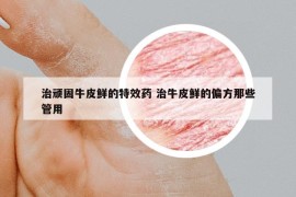 治顽固牛皮鲜的特效药 治牛皮鲜的偏方那些管用