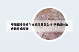 甲胺蝶呤治疗牛皮癣效果怎么样 甲氨蝶呤治疗银屑病原理