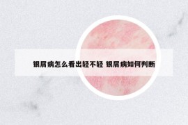 银屑病怎么看出轻不轻 银屑病如何判断