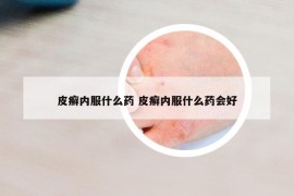 皮癣内服什么药 皮癣内服什么药会好