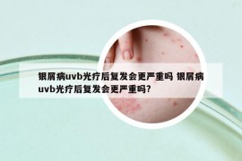 银屑病uvb光疗后复发会更严重吗 银屑病uvb光疗后复发会更严重吗?