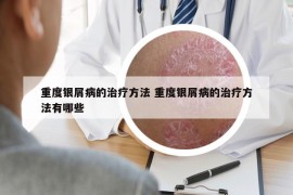 重度银屑病的治疗方法 重度银屑病的治疗方法有哪些